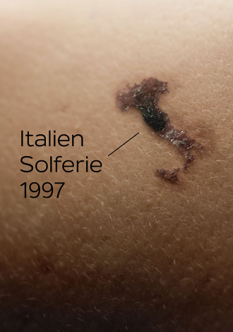 Foto af hud med et modermærke formet som Italien - Wire Agency